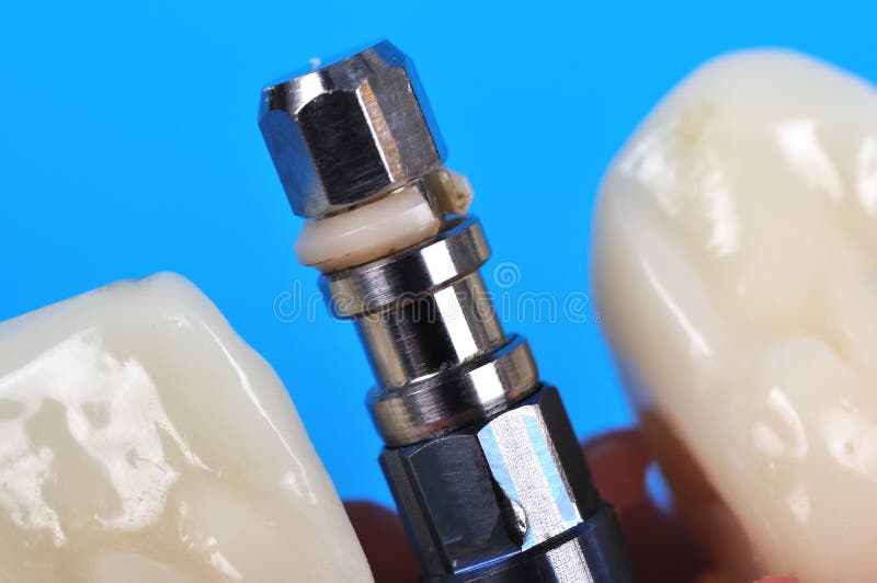 Dental implant