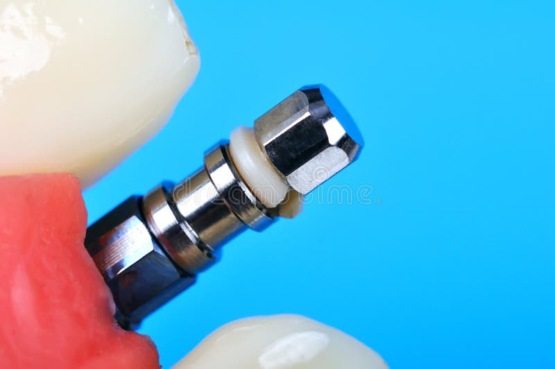 Dental implant