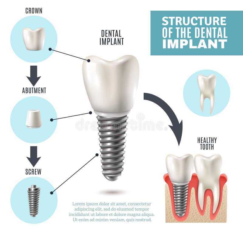 Dental Implant Structure Medical Infographic Poster