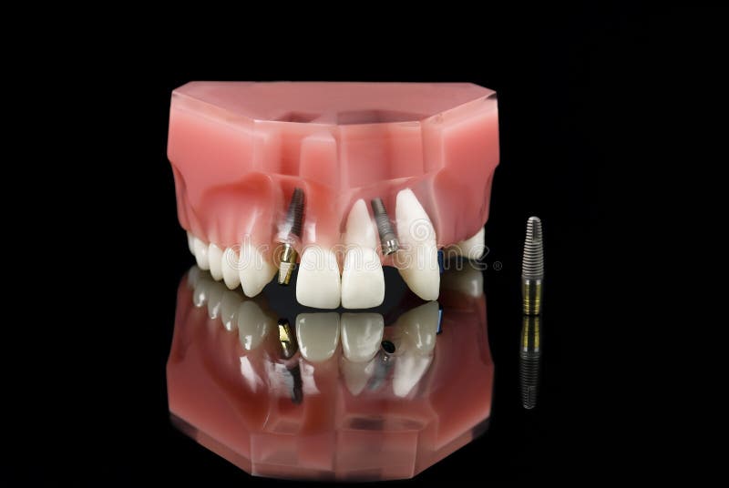 Dental Implant and Teeth Model Stock Photo Image of care, hygiene