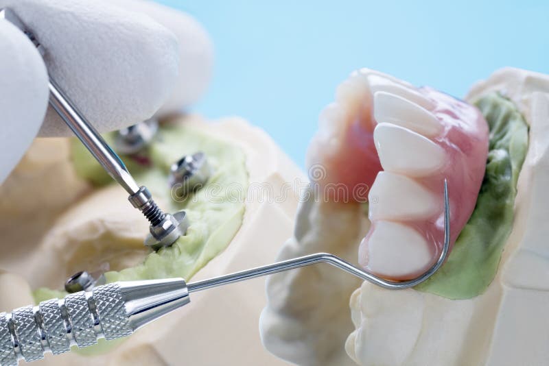 Dental Implant Work is Completed and Ready To Use. Stock Image Image