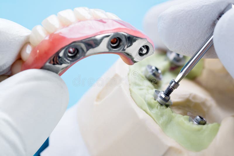 Dental Implant Work is Completed and Ready To Use. Stock Photo Image