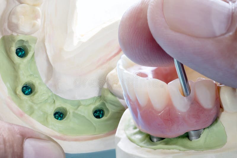 Dental Implant Work is Completed and Ready To Use. Stock Image Image