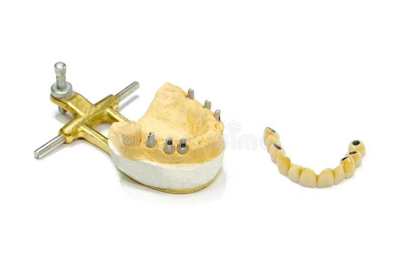 Dental Implants. Dental Ceramic Crowns on Implants. Artificial Teeth on
