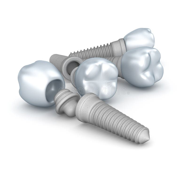 Dental Implants , Crown with Pin on White Stock Illustration