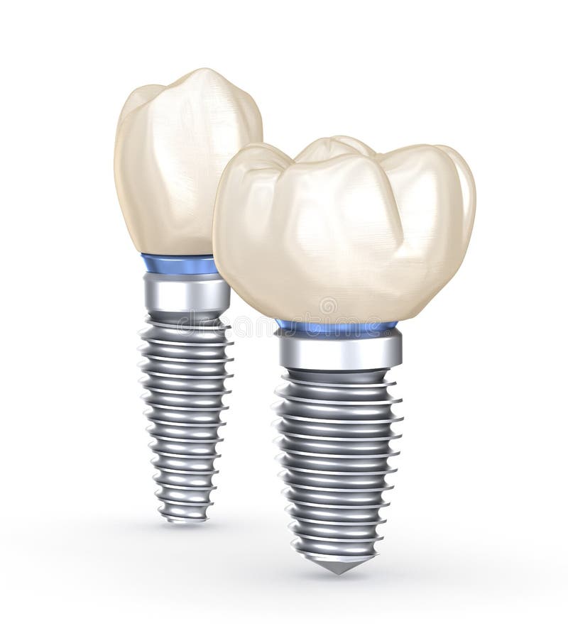 Dental Implants Stock Illustrations 1,546 Dental Implants Stock
