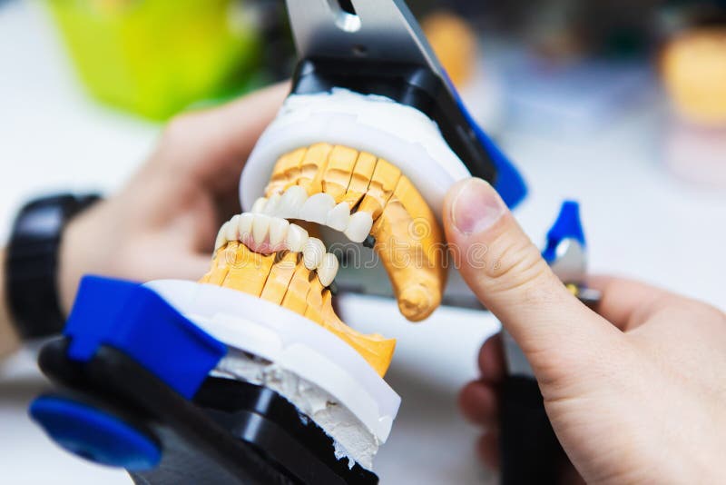 Dental Implants. the Formation of Bite of the Teeth. Denture Production