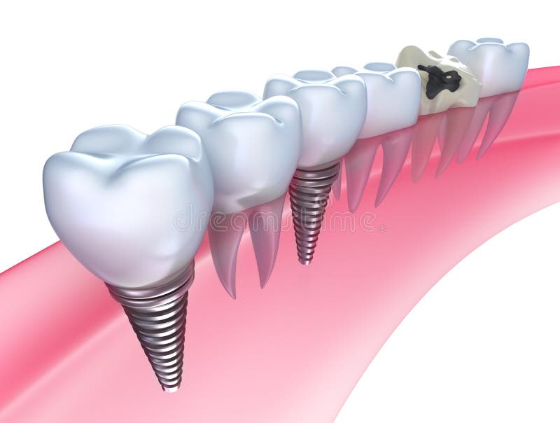 Implantes dentales en goma en blanco.