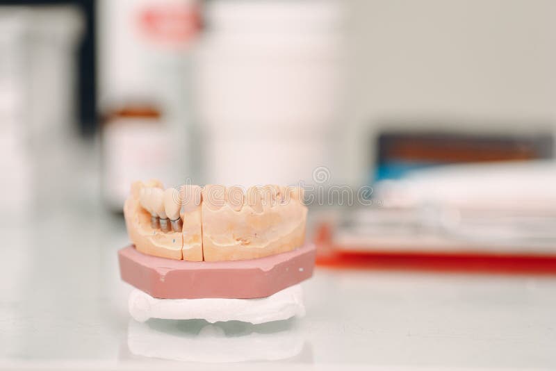 Dental Layout of the Human Jaw with Teeth and Implants. Stock Image