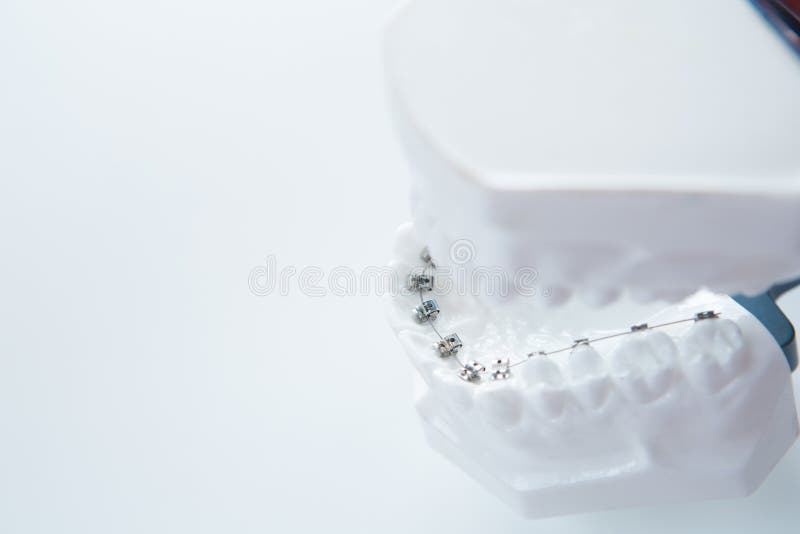 Dental Lower Jaw Bracket Braces Model on White Stock Photo Image of
