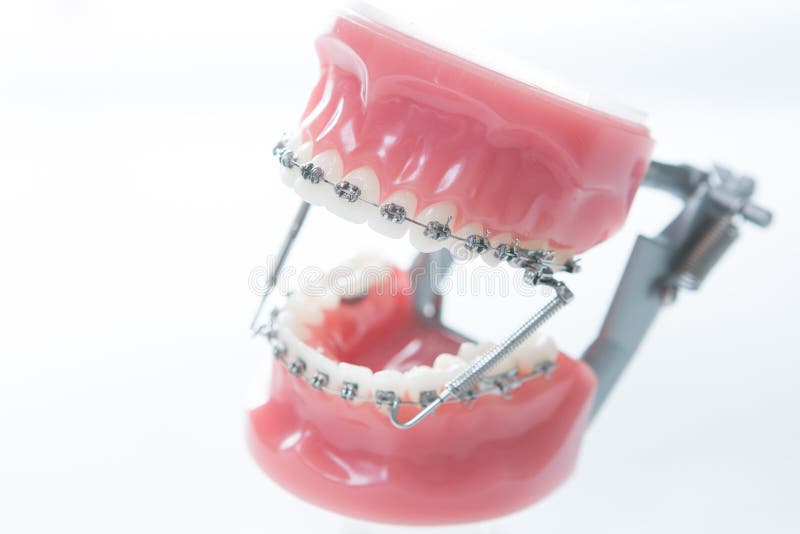 Dental Lower Jaw Bracket Braces Model on White Stock Image Image of