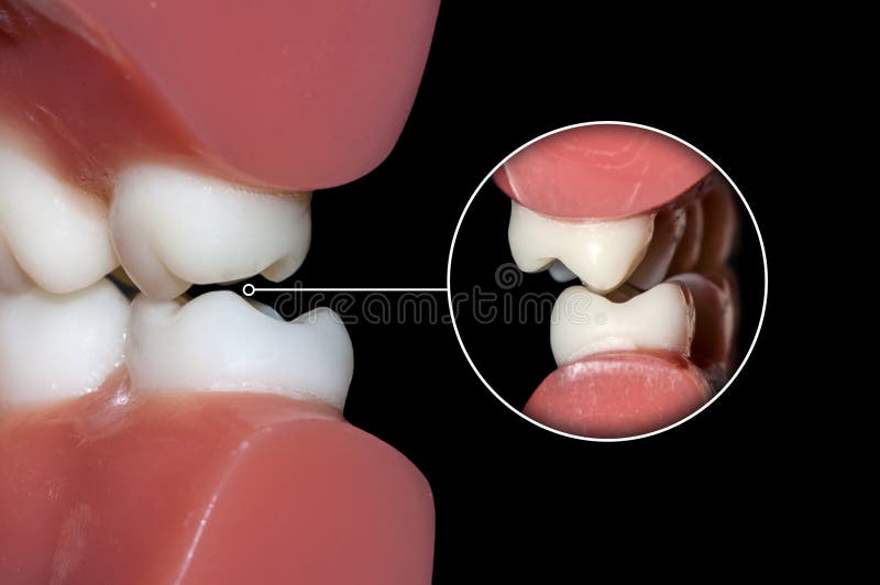 Dental Occlusion Molars Teeth Close Up Stock Photo Image of dentist