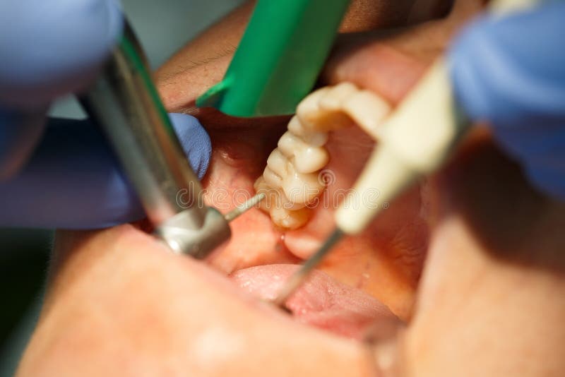 Dental patient getting her molar tooth cavity drilled