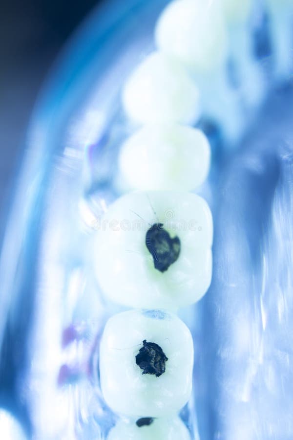 Dental plaque tooth decay stock image. Image of clinic 102236195