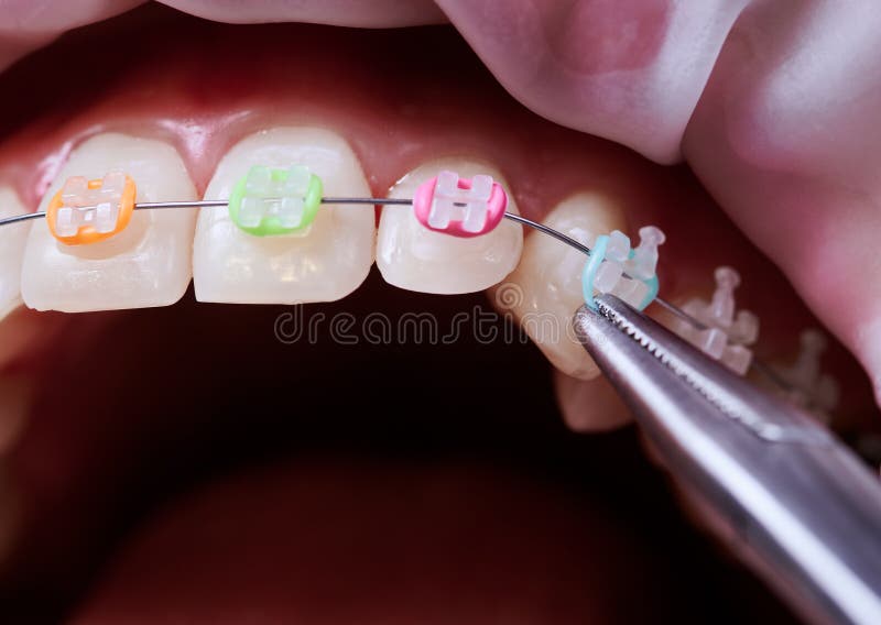 390+ Braces Rubber Bands Stock Photos, Pictures & Royalty-Free