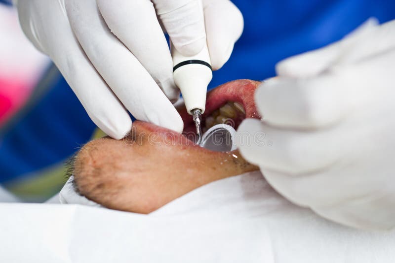 Dental Prophylaxis stock image. Image of patient, mirror 33145803