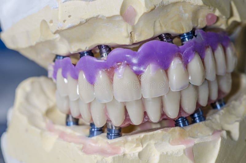 Dental Prosthesis Porcelain Teeth. Stock Photo Image of hygiene