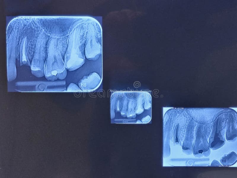 Dental Xray Image, Teeth Xray Film Stock Photo Image of radiography