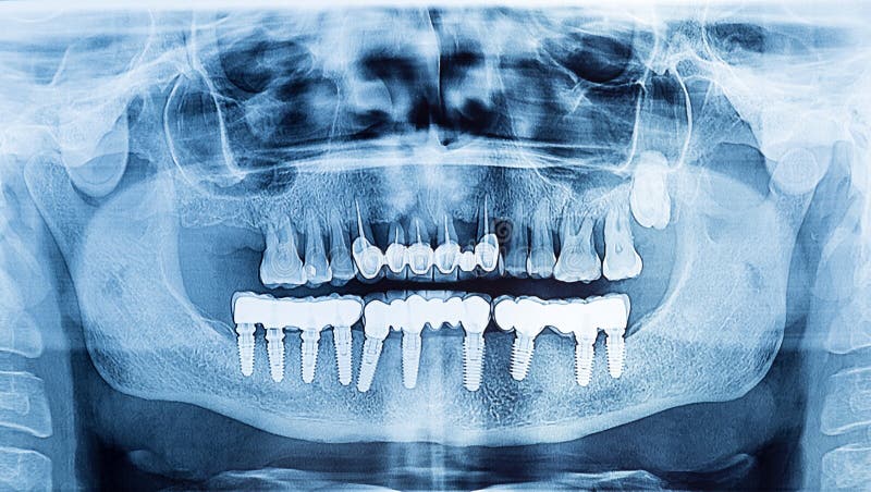 Dental X-Ray panoramic of upper and lower jaw.Dental implant pro royalty free stock images Dental X-Ray panoramic of upper and lower jaw.Dental implant pro royalty free stock images
