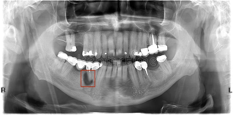 Фото перфораций зуба на рентгеновском снимке. Two tooths