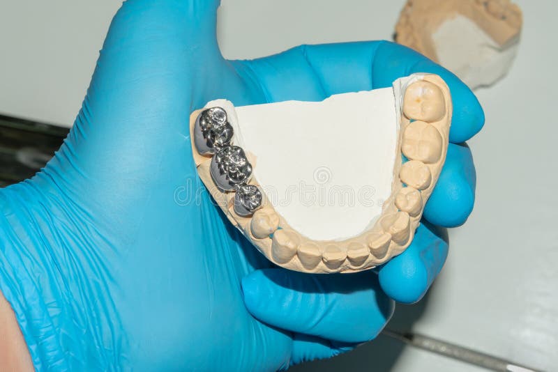 Dental Restoration of Rotten Roots of the Teeth with Ceramic Crowns. Cast Posts Dentistry Stock
