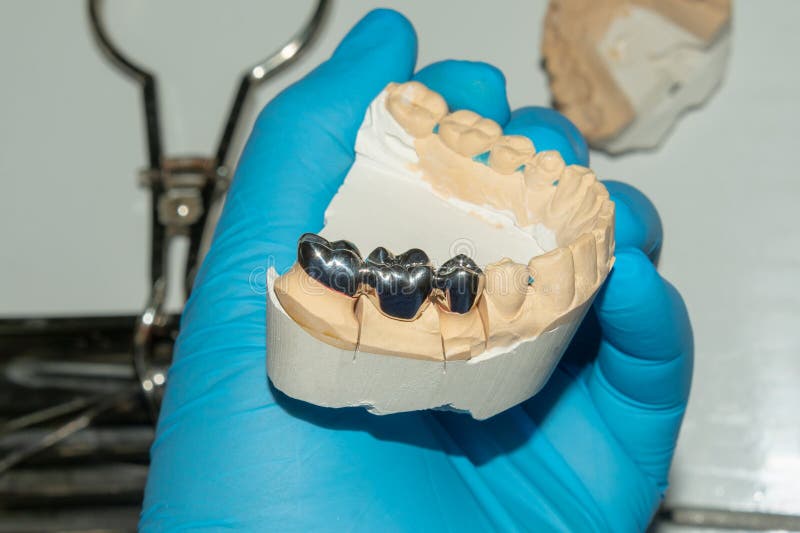 Dental Restoration of Rotten Roots of the Teeth with Ceramic Crowns