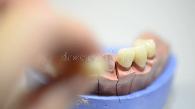 Dental technician working on 3D printed mold for tooth implants stock footage
