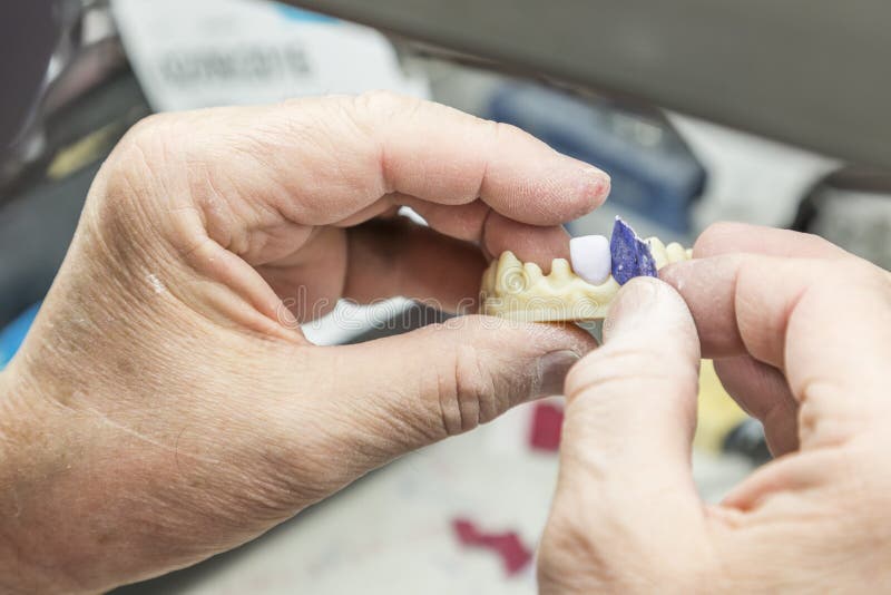 Dental Technician Working on 3D Printed Mold for Tooth Implants Stock
