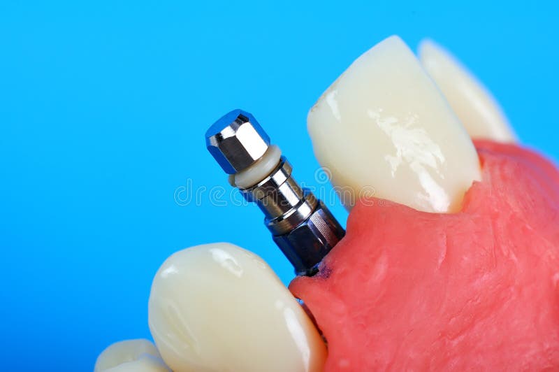 Dental Titanium Tooth Implant Stock Photo Image of prosthetic