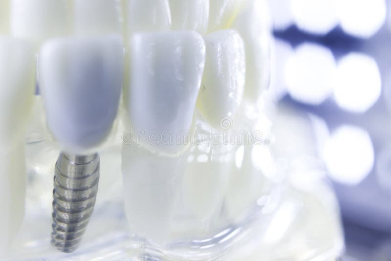 Dental titanium tooth implant royalty free stock images Dental titanium tooth implant royalty free stock images