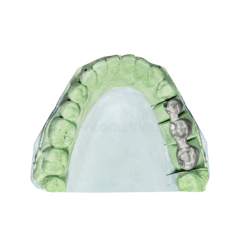 Dental Tooth Implant Plaster Pattern with Metal Bridge Isolated Stock