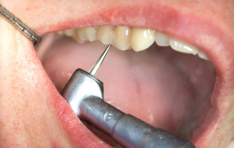 Dental treatment