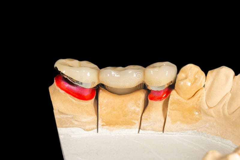 Dental Veneers, Ceramic and Zirconium Crowns of Teeth Closeup Macro Isolate on Black Background