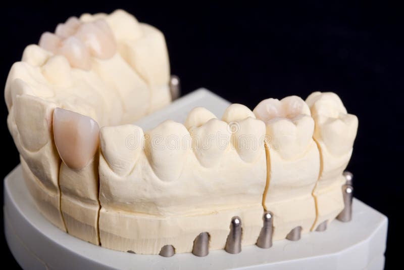 Dental wax model stock image. Image of cast, black, decay 17692601