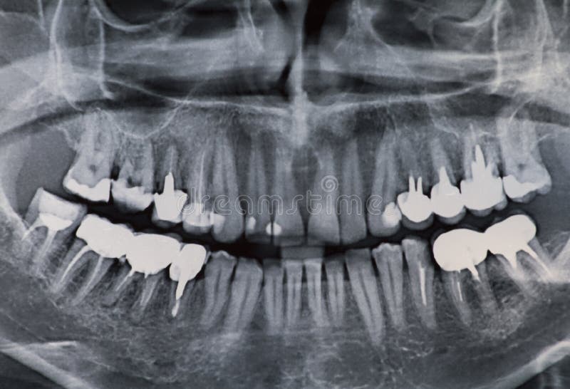 Dental xray stock photo. Image of head, plates, panoramic 53583146