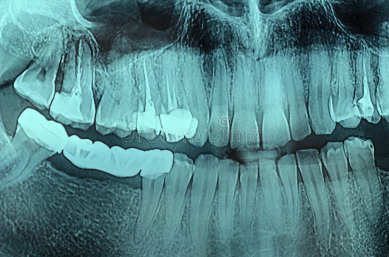 Dental Xray xray stock image. Image of head, examination 107221245