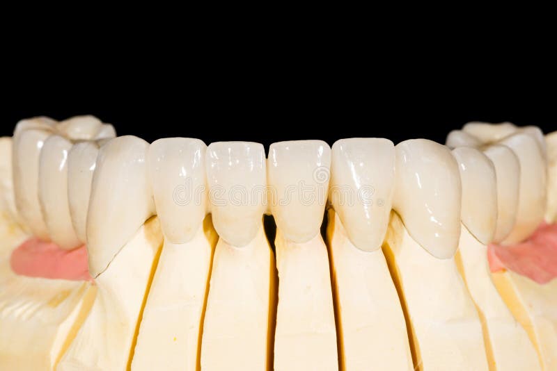 Dental zirconia bridge stock photo. Image of crown, artificial 94577104