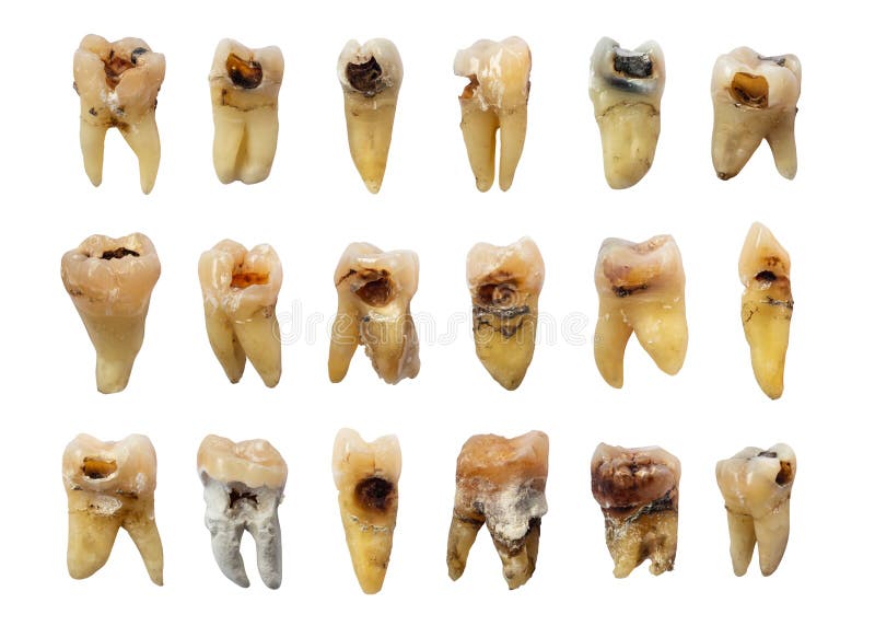 Dentatura con carie dentaria, i fluorosi ed il calcolo della carie dentale Fondo isolato