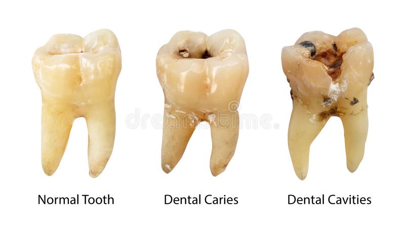 Dente normal, cárie dental e cavidade dental com cálculo A comparação entre a diferença dos dentes deteriora fases branco foto de stock royalty free Dente normal, cárie dental e cavidade dental com cálculo A comparação entre a diferença dos dentes deteriora fases branco foto de stock royalty free