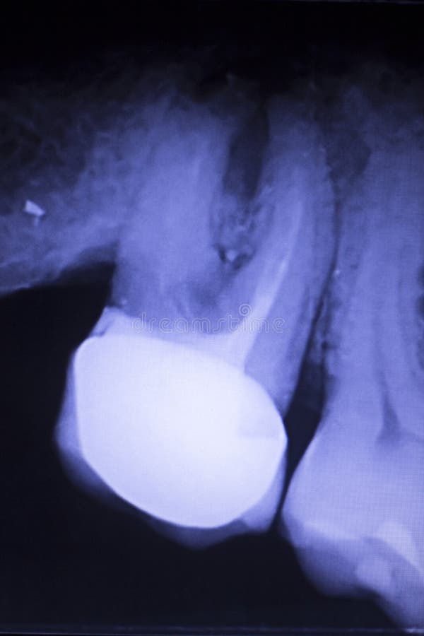 Dente que enche o raio X dental foto de stock Dente que enche o raio X dental foto de stock