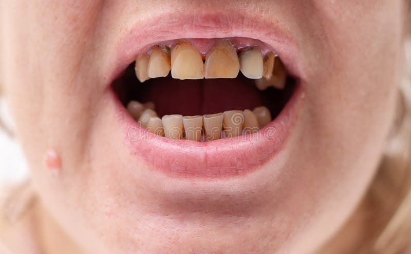 Dentes maus numa mulher fumante fotos de stock Dentes maus numa mulher fumante fotos de stock