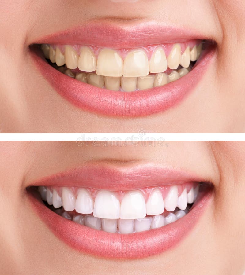 Dentes saudáveis e sorriso