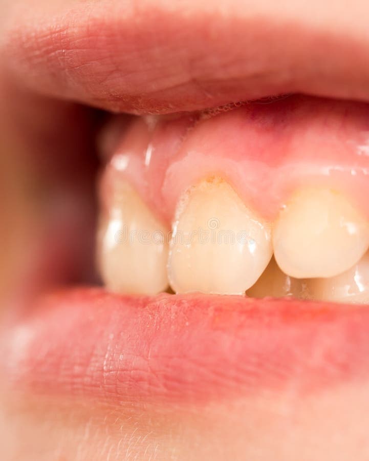 Fluorosi Denti Da Latte Denti da latte Macro fotografia stock. Immagine di sano - 106070720