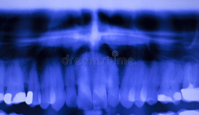 Denti dentari che riempiono ricerca dei raggi x dei dentisti fotografia stock Denti dentari che riempiono ricerca dei raggi x dei dentisti fotografia stock