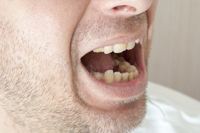 Denti malati del paziente