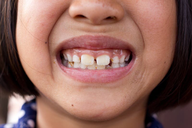 Denti non sani fotografia stock libera da diritti Denti non sani fotografia stock libera da diritti