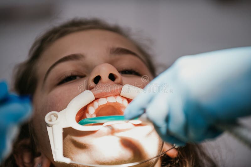 Dentist Appointment at a Dental Clinic, Placing Braces Locks on the