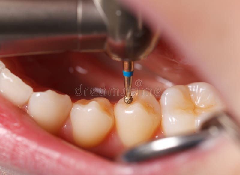 Dental drilling stock photo. Image of examine, drilling 29741026