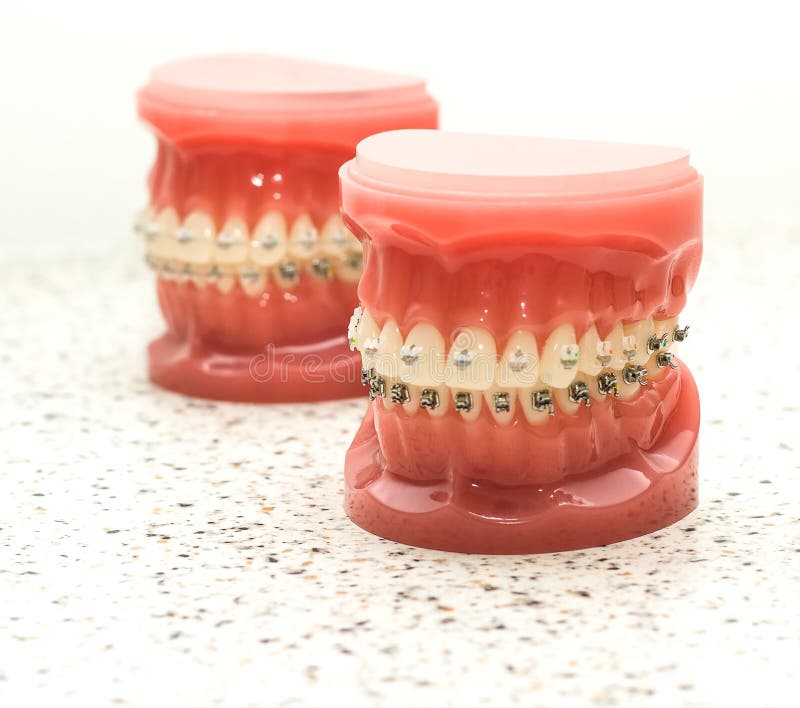 Dentist Demonstration Teeth Model of Orthodontic Bracket Stock Image