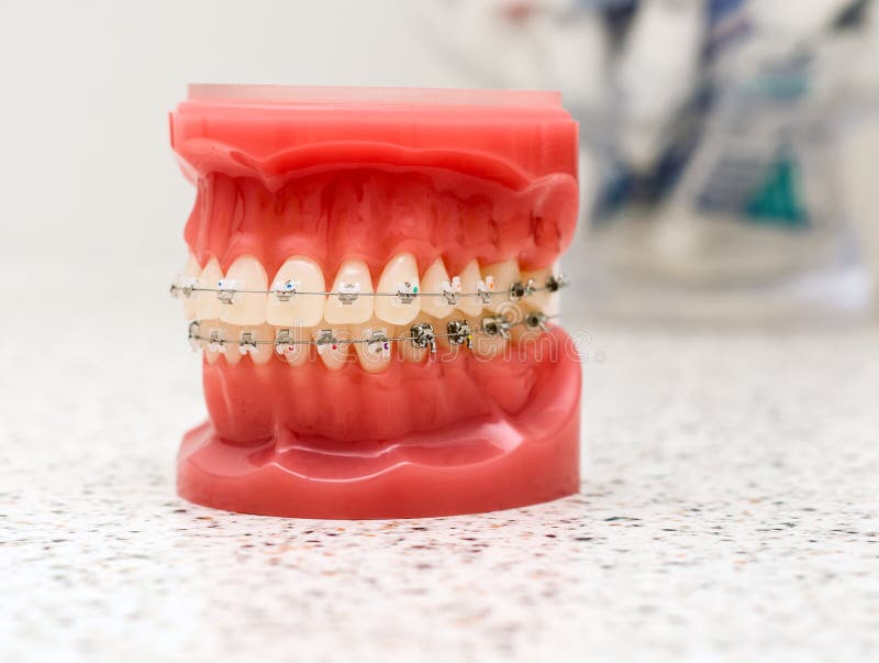 Dentist Demonstration Teeth Model of Orthodontic Bracket Stock Photo